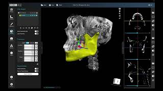 Superimpose STL Files on DICOM Scan in 3D [upl. by Marienthal475]