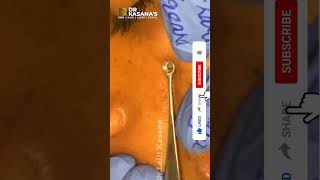 Dr Lalit Kasanas Treatments  How to Use Blackhead Removal Tool [upl. by Durward55]