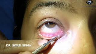 Lacrimal Syringing Technique and Interpretation [upl. by Hallam]