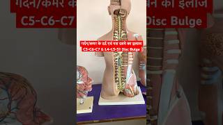 Cervical Problem amp Lower Back Pain Treatment shorts sciatica neckpain [upl. by Colville830]