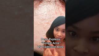 Why those tiny bumps arent Fungal Acne [upl. by Icyaj988]