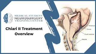 Chiari II Treatment Overview [upl. by Seidnac978]