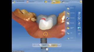 Coroane dentare si bont protetic realizate digital intro singura sedinta cu Cerec CadCam [upl. by Aistek]