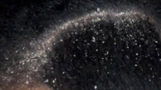 Dandruff Scratching Scalp Eczema Scaly Patches of Flakes Flying [upl. by Oicnecserc]