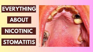 Nicotinic Stomatitis Explained Causes Symptoms and Treatment Options  InDepth Lecture [upl. by Assyla730]