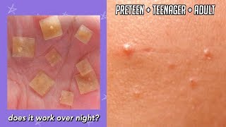 TESTING ACNE PIMPLE STICKERS OVER NIGHT on PRETEEN TEENAGER  ADULT SKIN [upl. by Charlton]