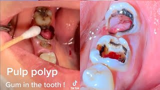 Pulp polyp interesting tiktok video [upl. by Digirb]