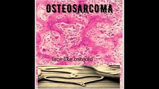 Bone Tumors Osteosarcoma radiology and pathology [upl. by Aisitel]