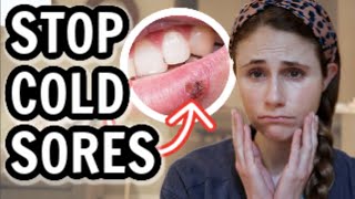 How to treat cold sores FAST Dr Dray [upl. by Yrelav]