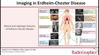 Imaging in ErdheimChester Disease dr Sara NASR [upl. by Hatokad]