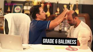 How Grade 6 hair Transplant in one days is possible  Dr Suneet Soni  Medispa Hair Transplant India [upl. by Rudelson]