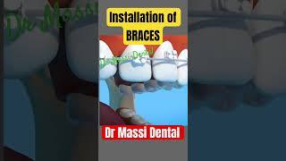 Installation of Braces [upl. by Haisi211]