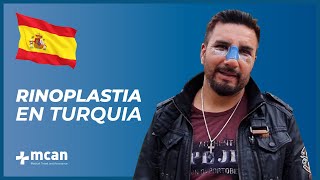 Rinoplastia en Turquía con MCAN Health [upl. by Llenrag162]