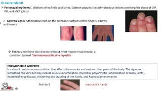 19 Polymyositis and Dermatomyositis [upl. by Lebasile22]