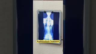 Kyphoscoliosis treatment by DrRavi scoliosistreatment kyphosis spine chiro short reeltrending [upl. by Amisoc]