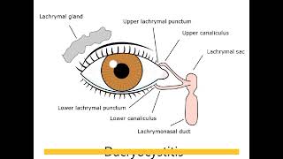 DACRYOCYSTITIS  Definition of DACRYOCYSTITIS Type of dacryocystitis✨ [upl. by Suoivart]