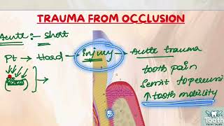 Trauma from occlusionTFO Periodontics lectures part 1 [upl. by Perlie]