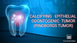 CALCIFYING EPITHELIAL ODONTOGENIC TUMOR PINDBORGS TUMOR [upl. by Asreht198]