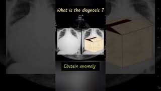 Ebstein anomaly radiology neetpg neet2024 [upl. by Bradly]