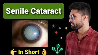 Senile cataract lecture opthalmology [upl. by Martie]