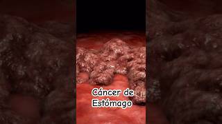 ¡Alerta Signos y síntomas de cáncer de estómago  Dr William Guerrero medicina shorts [upl. by Donetta378]