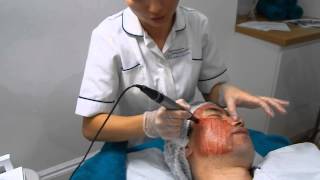 DERMAPEN Skin Needling For Acne Scarring [upl. by Anyahs]