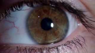 Nistagmus rotatorio  Rotary Nystagmus [upl. by Asor496]