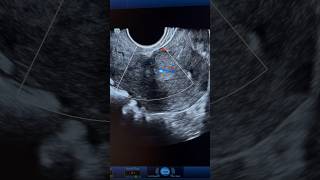 Endometrial Polyp Ultrasound with internal vascularity  ARDMS Sonography  obgyn [upl. by Aneetsyrk]