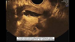 HysteroSoNogram  salineair mixture [upl. by Eniortna]