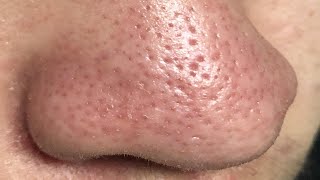 how to get rid of clogged pores on nose permanently [upl. by Wixted]