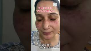 Freckles treatment with laser Single sitting result holi ytshorts delhi holiskincare skincare [upl. by Altman]