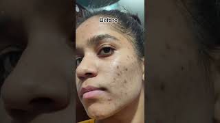 Tretinoin cream 0025 before and after 1 YEAR OF TRETINOIN tretinoin shortsfeed tretinoincream [upl. by Atinus647]