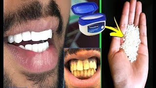 In Just 2 Minutes Turn Yellow Teeth To Pearl White and Shine Teeth Whiten at Home everyday culture [upl. by Anaej]