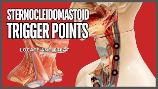 Understanding Trigger Points in the Sternocleidomastoid Muscle [upl. by Suertemed]