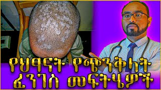 የህፃናት የጭንቅላት ፈንገስ መፍትሄዎች  Dr Fasil [upl. by Lakym239]