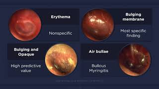 Acute Otitis Media Otoscopic Findings [upl. by Adnaerb980]