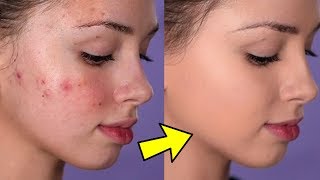 How To Cover Acne and Blemishes  EASY amp NONCAKEY [upl. by Cornell]