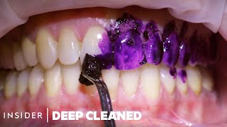 How Teeth Are Professionally Deep Cleaned  Deep Cleaned [upl. by Ardnaek]