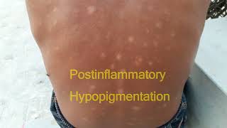 Postinflammatory Hypopigmentation [upl. by Vierno686]