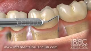 Periodontal disease causes and treatment [upl. by Ayal]