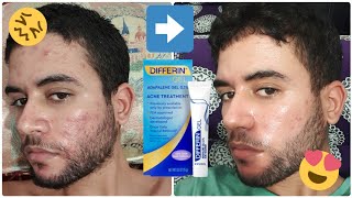 My 4 Months Acne Journey Using Differin Gel before and after [upl. by Sadella44]