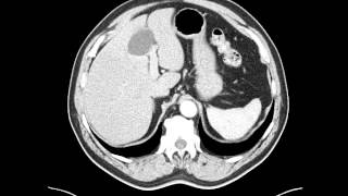 Esophageal leiomyoma distal esophagus  CT [upl. by Veedis61]