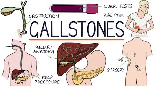 Understanding Gallstones [upl. by Isaiah506]