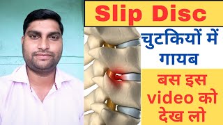 Slipped Disc Treatmentslippeddisc [upl. by Angid]