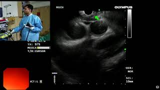 EUS Anatomy of mediastinum [upl. by Boonie]