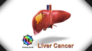 Liver Cancer  Symptom Causes amp Diagnosis Finding Earth [upl. by Enyaht155]