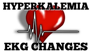 Hyperkalemia or High Potassium Level EKG Changes Quick amp EZ Episode 7 [upl. by Scoville]