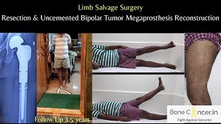 Treatment for Bone CancerChondrosarcomaFemurLimb Salvage SurgeryTumor Prosthesis DrSrimanth BS [upl. by Uzia300]