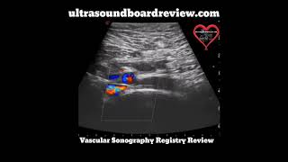 MayThurner Syndrome Ultrasound [upl. by Hannavas]