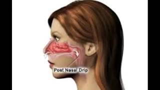 Wie zur Behandlung und Heilung post nasal drip [upl. by Narol]